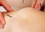 Dry Needling